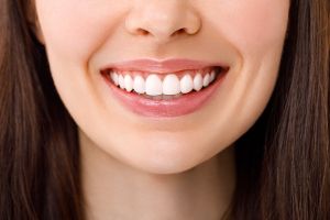 Woman Smiling With Dental Veneers