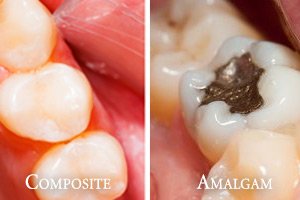 Composite vs Amalgam Fillings