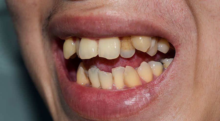 Teeth with stains and misalignment